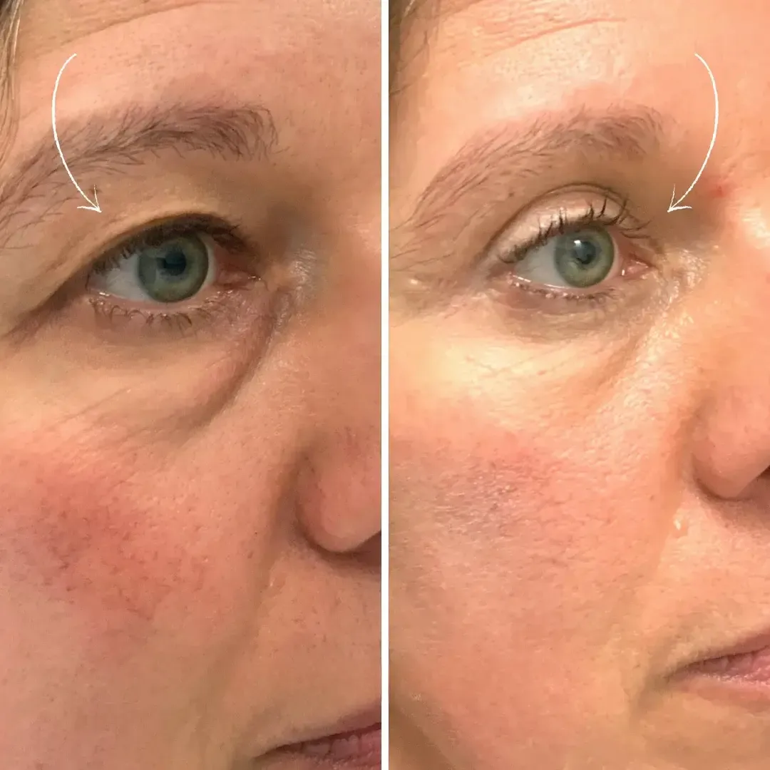 LiftLid™ | Løft hængende øjenlåg – uden Botox eller kirurgi