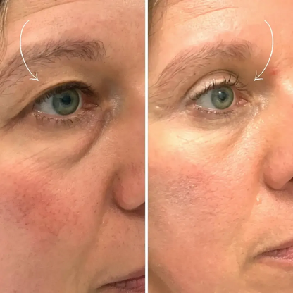 LiftLid™ | Løft hængende øjenlåg – uden Botox eller kirurgi