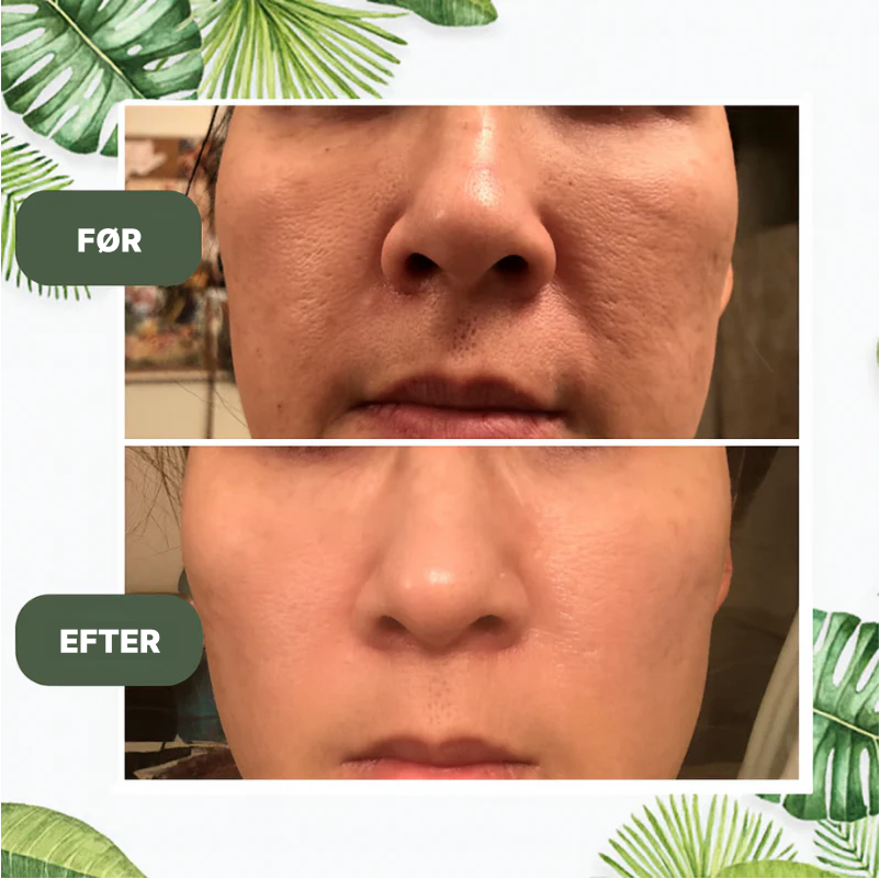 DermaPop™ | Eliminér akne og urenheder hurtigt – fremhæv din naturlige glød