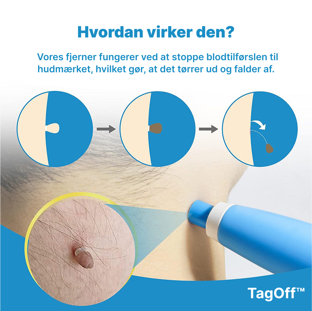 TagOff™ | Enkel og naturlig fjernelse derhjemme (1–2 uger)