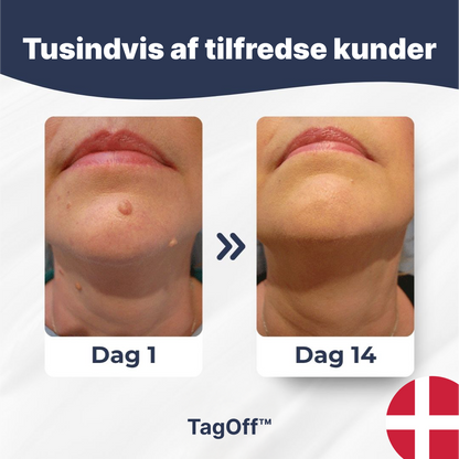 TagOff™ | Enkel og naturlig fjernelse derhjemme (1–2 uger)
