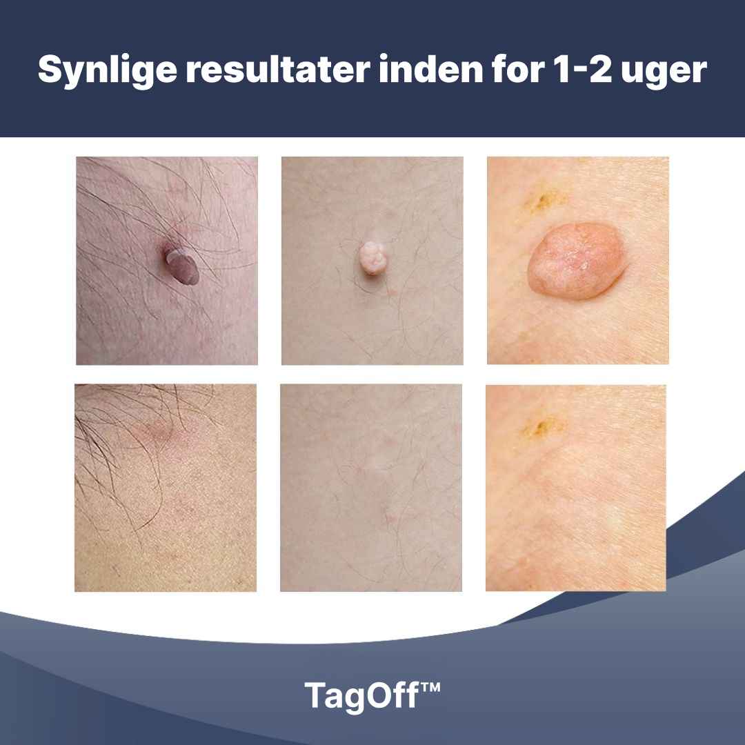 TagOff™ | Enkel og naturlig fjernelse derhjemme (1–2 uger)