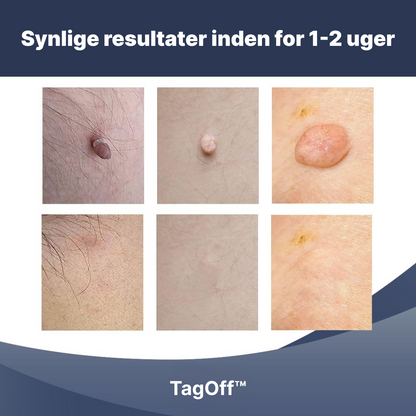 TagOff™ | Enkel og naturlig fjernelse derhjemme (1–2 uger)
