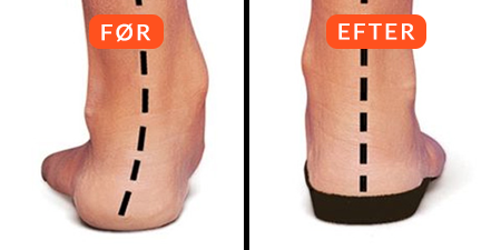 PowerStep™ — Øjeblikkelig lindring til ægte fodsmerter
